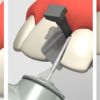 FenderWedge® Prep - Image 2